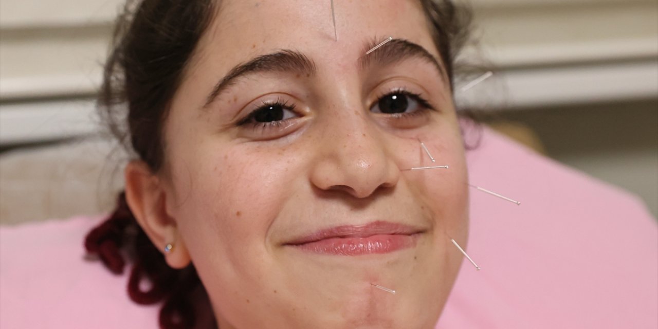 Yüz felci geçiren 10 yaşındaki çocuk akupunktur ile sağlığına kavuştu