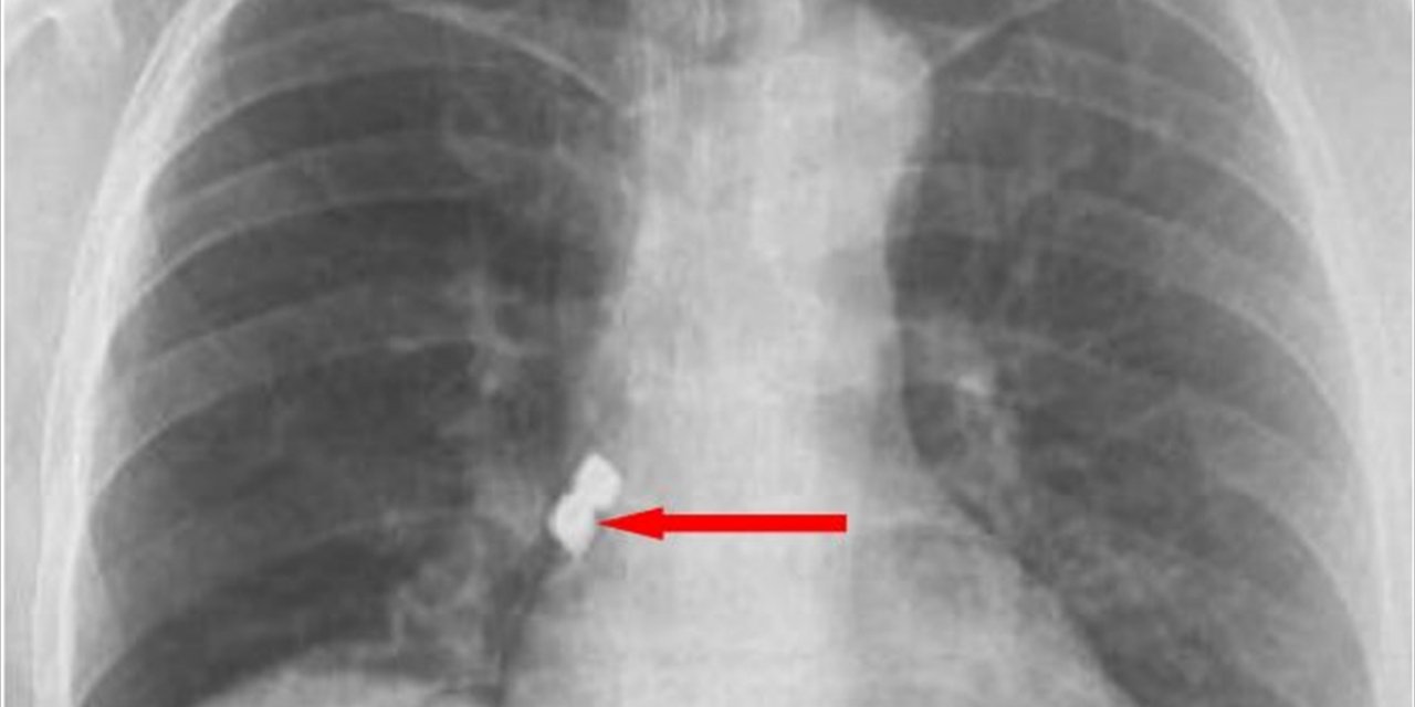 Afyonkarahisar'da bir kişinin soluk borusuna kaçan 2 implant çıkarıldı