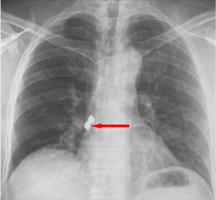 Afyonkarahisar'da bir kişinin soluk borusuna kaçan 2 implant çıkarıldı